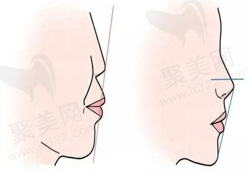李继华医生偏颌矫正的手术价格