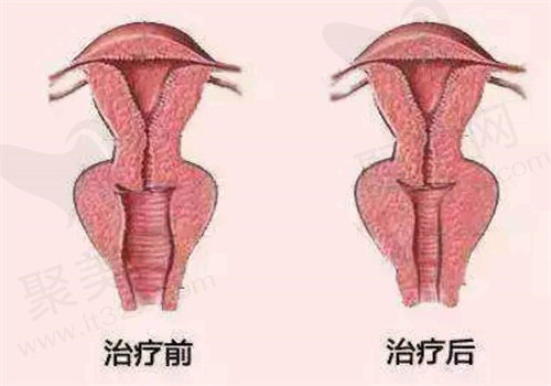 北京嘉禾妇儿医院侯智慧医生私密手术价格