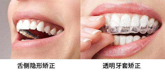 舌侧矫正或隐形牙套哪个更好？舌侧矫正更快吗