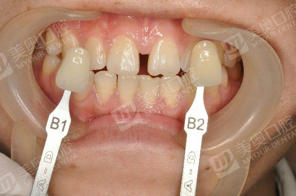 南通牙齿不齐有什么影响？