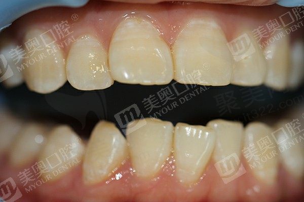 牙齿矫正材料的分类是怎样的？