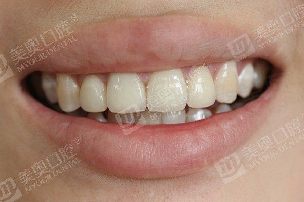 杭州牙齿矫正有哪些好处？