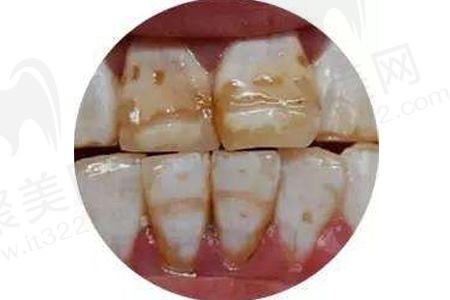 氟斑牙和涂氟互相矛盾么？它们之间有什么关系？