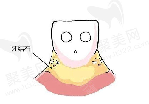 牙结石有什么危害？洗牙可以去除牙结石吗？