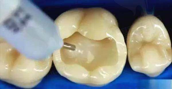 去牙科医院做了树脂补牙一般能用多少年