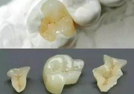 传统补牙与嵌体修复有不同？该怎么选择？