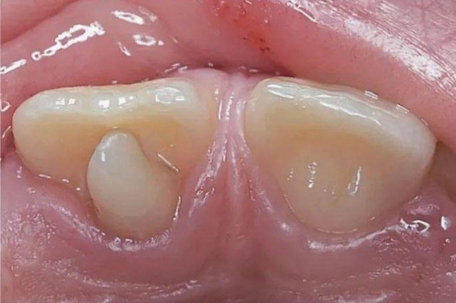 什么是多生牙，多生牙一定要拔么