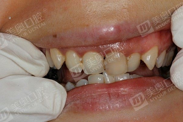 南京刚补完牙要注意什么
