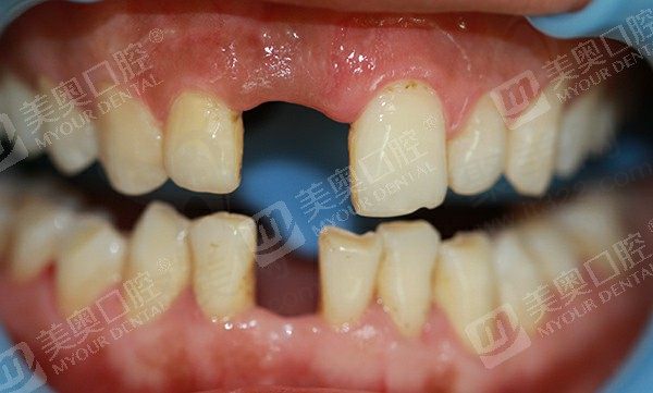 通常牙齿缺失治疗方法有哪些？美奥口腔告诉你