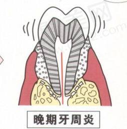 有了急性牙周炎怎么办