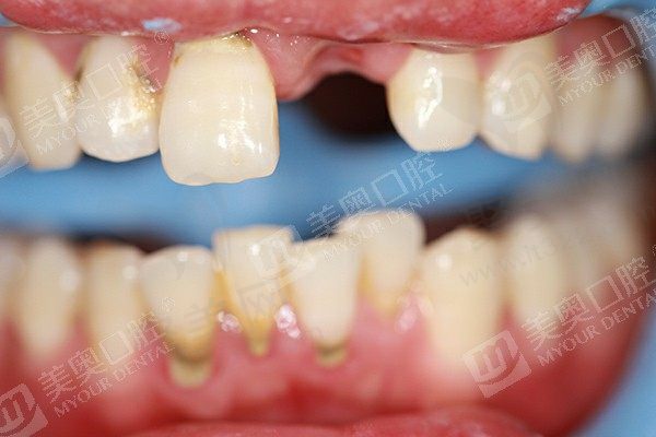 杭州美奥口腔治疗牙齿缺失是怎么收费的？