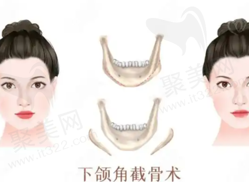 青岛壹美天成孙淼医生眼部整形怎么样？