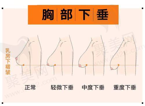 实例一：李小姐的隆鼻体验