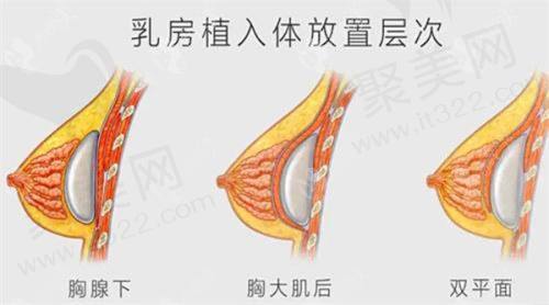 成都新华医院整形科刘勇万和假体隆胸11250元起，专业医生助力打造理想美胸效果
