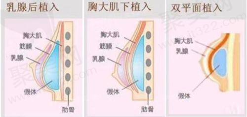 二、成都新华医院整形科刘勇万和假体隆胸的价格情况