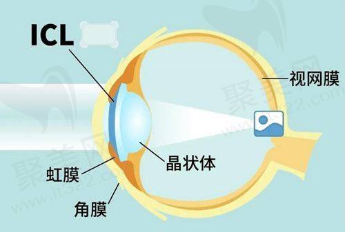 海口国爱眼科干眼SPA理疗的作用与成效