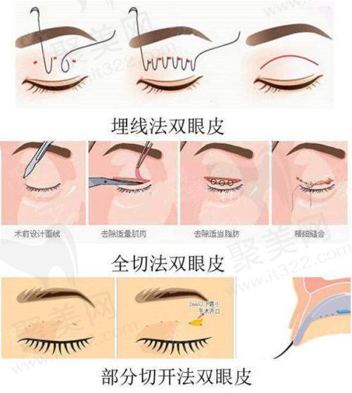 2. 吸脂项目价格明细