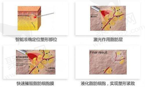 惠州皇佳蝶美医疗美容诊所陈满擅长项目