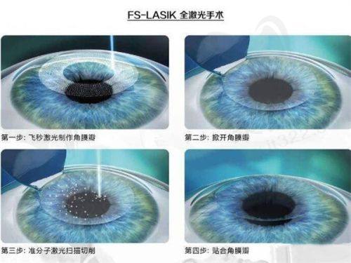 海口国爱眼科干眼SPA理疗的技术水平