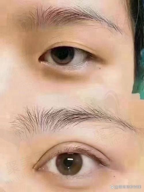 三、大连爱德丽格宋立男医生提肌手术技术优势