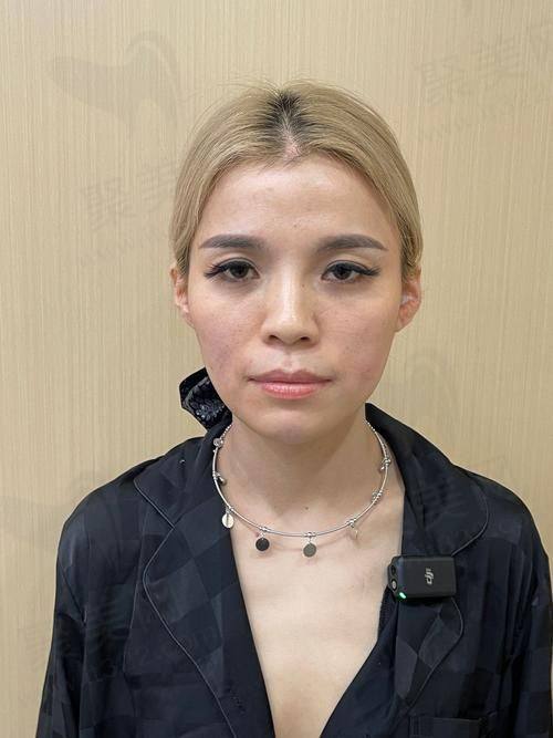 一、玻尿酸面部填充的基本认知