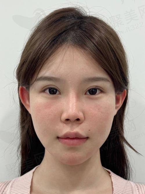 二、玻尿酸面部填充的安心性分析