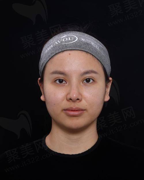 三、玻尿酸面部填充的常见后遗症