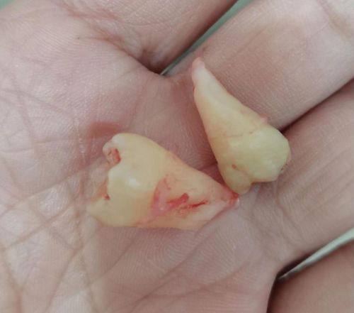 五、医院拔智齿当天拔吗？常见并发症及处理方法
