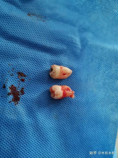三、医院拔智齿当天拔吗？拔智齿的流程揭秘