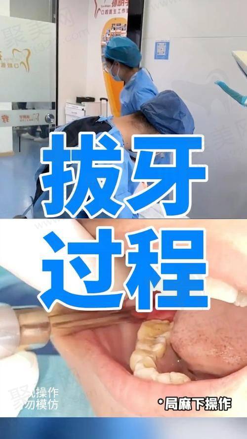 二、医院拔智齿当天拔吗？拔智齿前的准备工作