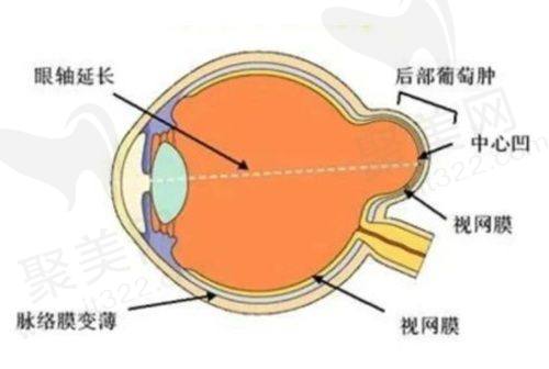 青光眼的治疗技术与手术类型