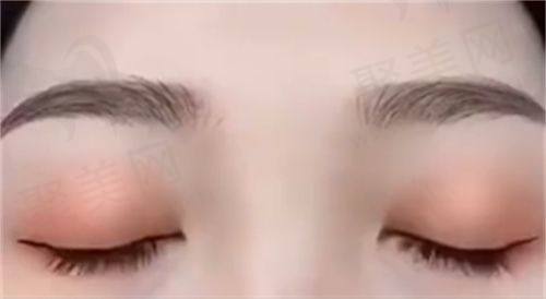 洛阳孔繁荣医疗美容吸脂去副乳的作用与成效