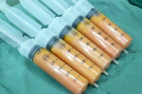 哈尔滨羽禅整形杨宇梓曼托假体隆胸的技术优势