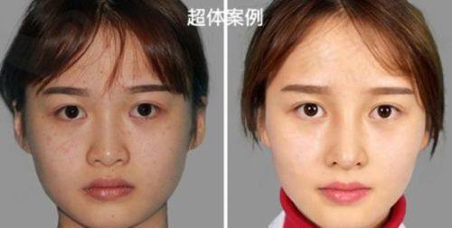 西安西美整形耳软骨隆鼻：成就自然美鼻梦想