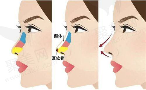 南宁芭芘丽整形妈生鼻鼻综合3项医院收费标准参考