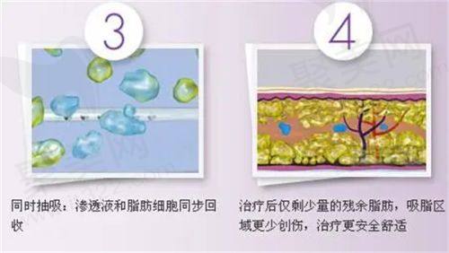 哈尔滨羽禅医美姣兰玻尿酸丰唇的专精团队