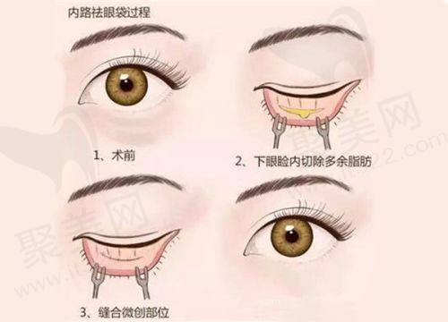 什么是 SRT - 100？