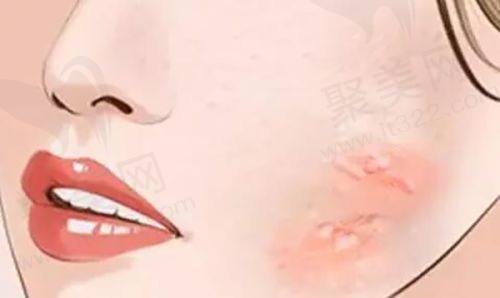 哈尔滨羽禅医美姣兰玻尿酸丰唇的技术优势