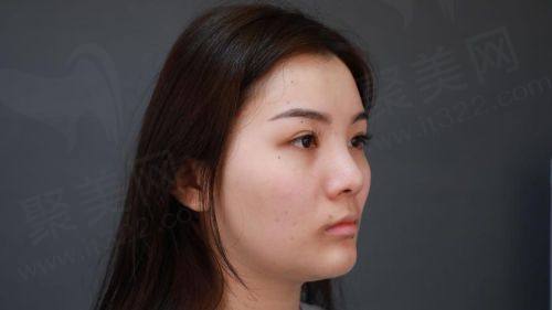 四、西安西美整形耳软骨隆鼻技术特色