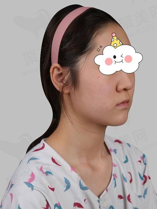 二、西安西美整形耳软骨隆鼻价格情况