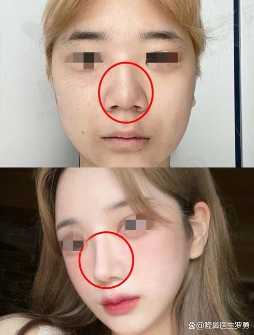 五、西安西美整形耳软骨隆鼻成功实例分享
