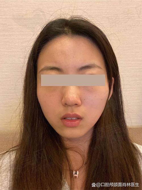 与其他医生价格对比，李继华颧骨颧弓内推贵吗？