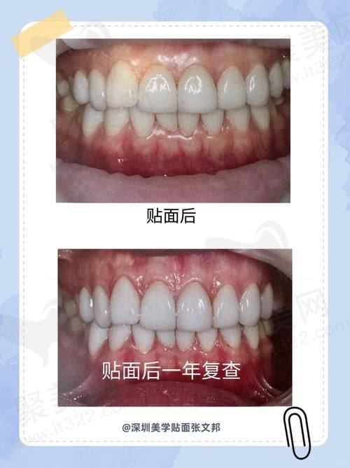 四、西安团圆口腔半口牙贴面的成功实例