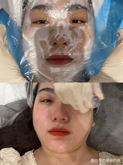 上海美莱申涛医生打玻尿酸怎么样？