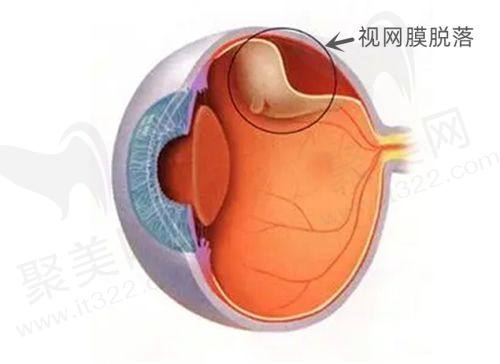 大连爱尔眼科三焦点人工晶体手术35000元起，解决多屈光问题，术后无需老花镜