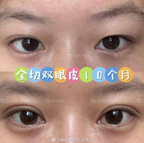 南宁芭芘丽整形芭芘翘睫电眼综合5项有哪些技术优势呢？