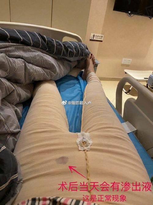 成都八大处整形唐勇院长吸脂成效：惊艳又满意
