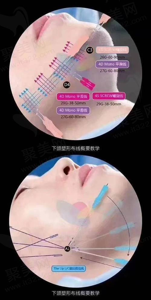 南宁芭芘丽医疗美容埋线提升的显著作用