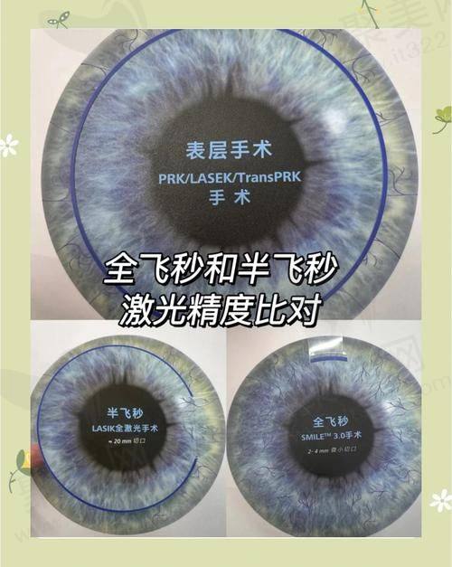 二线城市飞秒手术价格情况