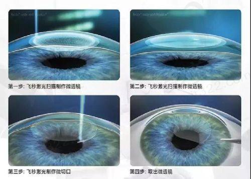 2025飞秒手术及近视手术价格参考总览